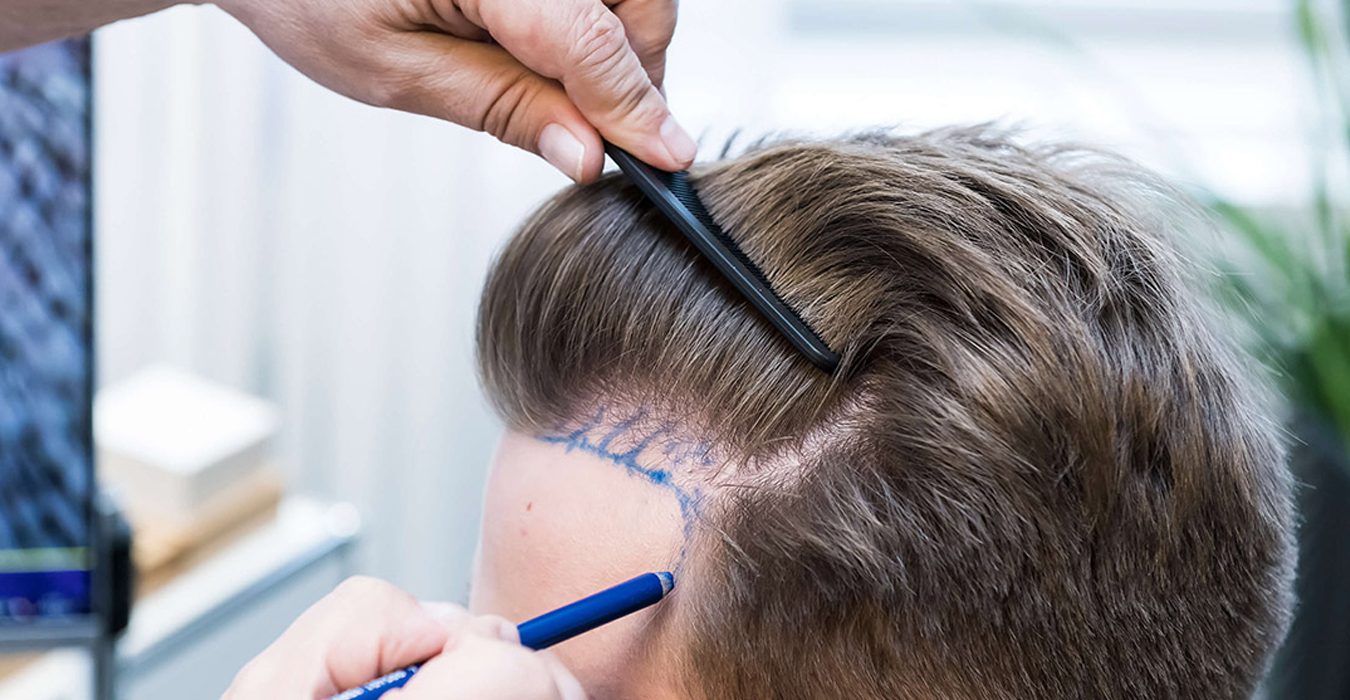 Mesotherapy for hair loss